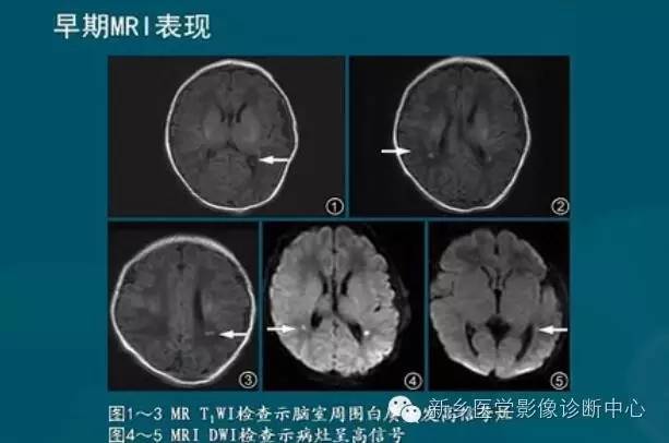 【PPT】新生儿缺氧缺血性脑病影像学表现