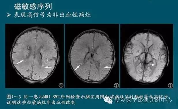 【PPT】新生儿缺氧缺血性脑病影像学表现