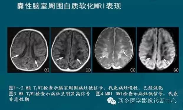 【PPT】新生儿缺氧缺血性脑病影像学表现