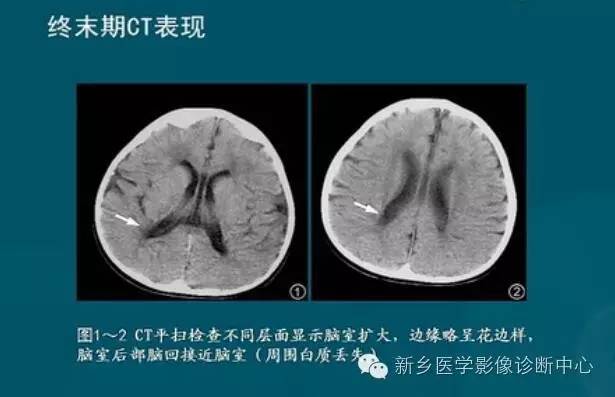 【PPT】新生儿缺氧缺血性脑病影像学表现