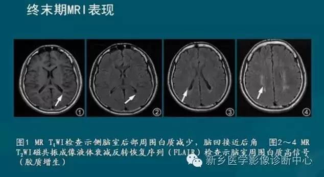 【PPT】新生儿缺氧缺血性脑病影像学表现