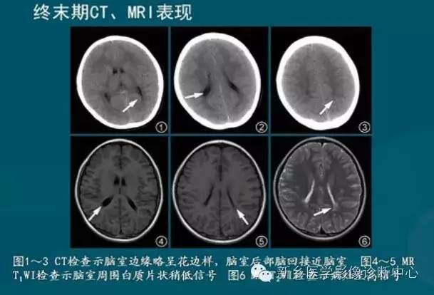 【PPT】新生儿缺氧缺血性脑病影像学表现