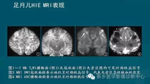 【PPT】新生儿缺氧缺血性脑病影像学表现