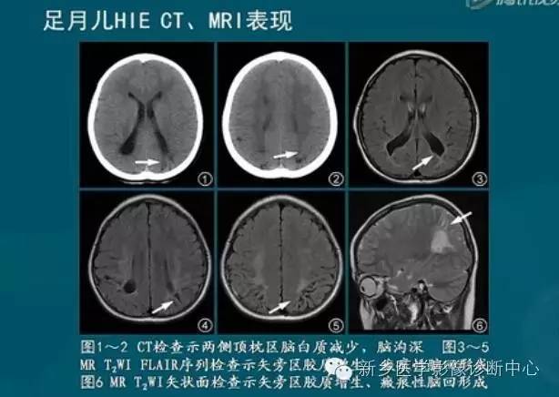 【PPT】新生儿缺氧缺血性脑病影像学表现