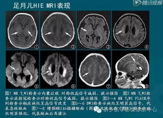 【PPT】新生儿缺氧缺血性脑病影像学表现