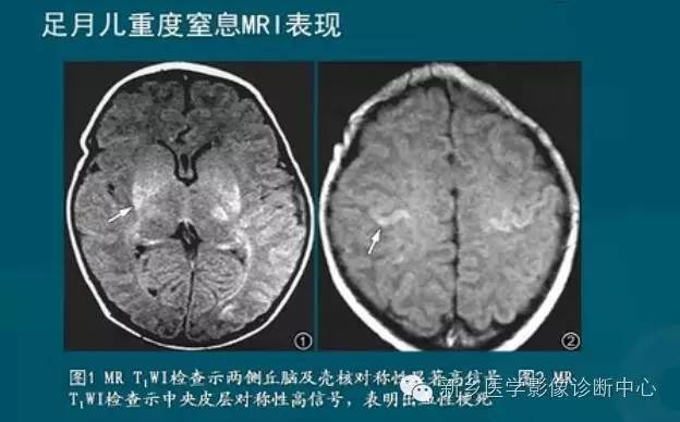 【PPT】新生儿缺氧缺血性脑病影像学表现