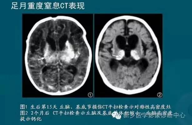 【PPT】新生儿缺氧缺血性脑病影像学表现