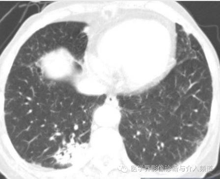 【病例】肺结节性淋巴样组织增生1例CT影像表现