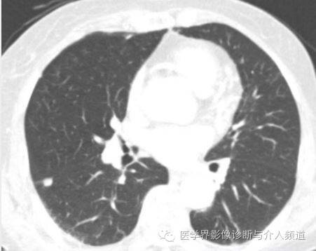 【病例】肺结节性淋巴样组织增生1例CT影像表现 【病例】肺结节性淋巴样组织增生1例CT影像表现