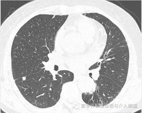 【病例】肺结节性淋巴样组织增生1例CT影像表现 【病例】肺结节性淋巴样组织增生1例CT影像表现