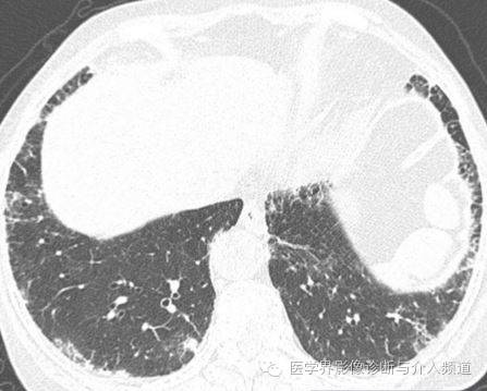 【病例】肺结节性淋巴样组织增生1例CT影像表现 【病例】肺结节性淋巴样组织增生1例CT影像表现