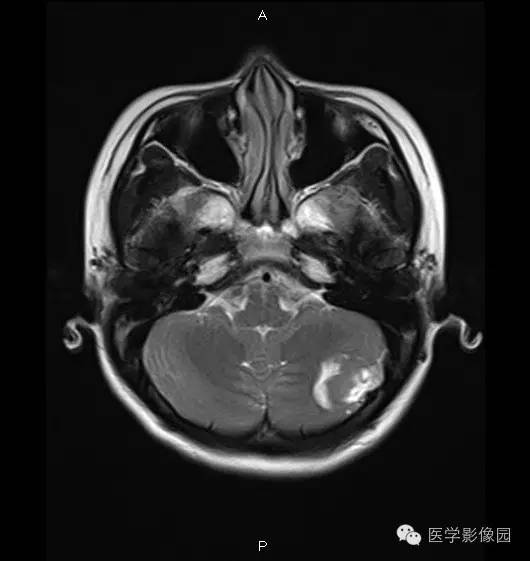 【病例】小脑半球表皮样囊肿1例MR影像表现