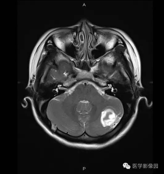 【病例】小脑半球表皮样囊肿1例MR影像表现