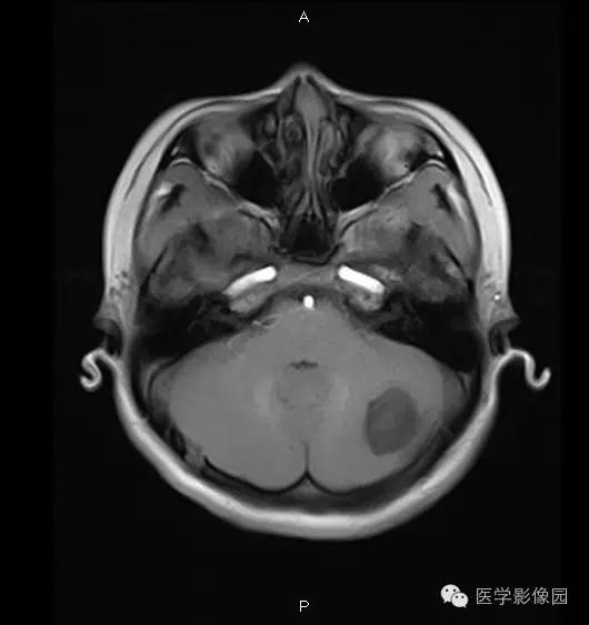 【病例】小脑半球表皮样囊肿1例MR影像表现