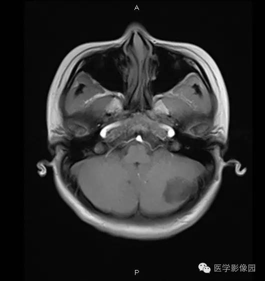 【病例】小脑半球表皮样囊肿1例MR影像表现
