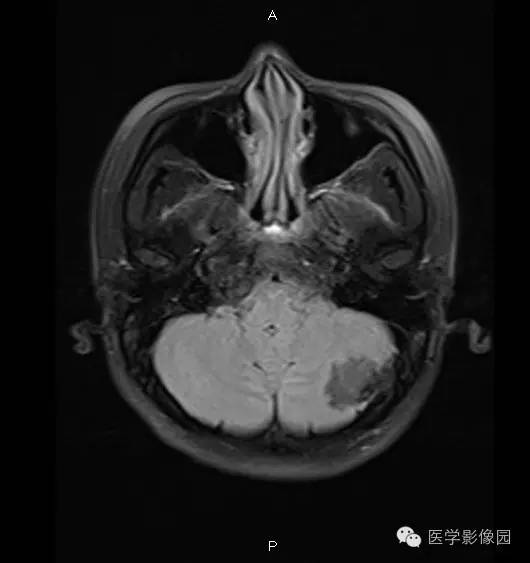 【病例】小脑半球表皮样囊肿1例MR影像表现