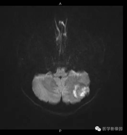 【病例】小脑半球表皮样囊肿1例MR影像表现