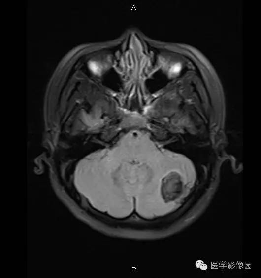 【病例】小脑半球表皮样囊肿1例MR影像表现