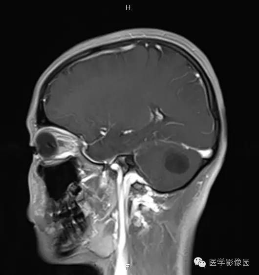 【病例】小脑半球表皮样囊肿1例MR影像表现