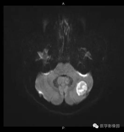 【病例】小脑半球表皮样囊肿1例MR影像表现