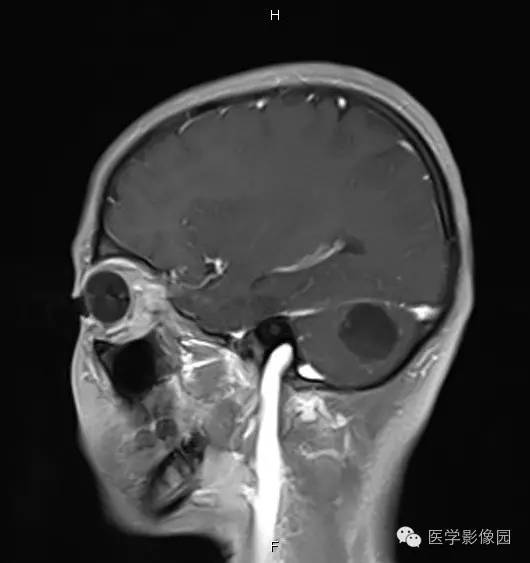 【病例】小脑半球表皮样囊肿1例MR影像表现