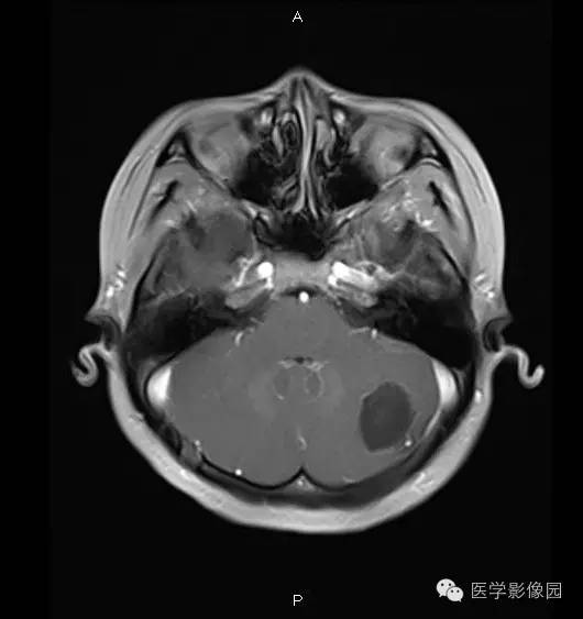 【病例】小脑半球表皮样囊肿1例MR影像表现