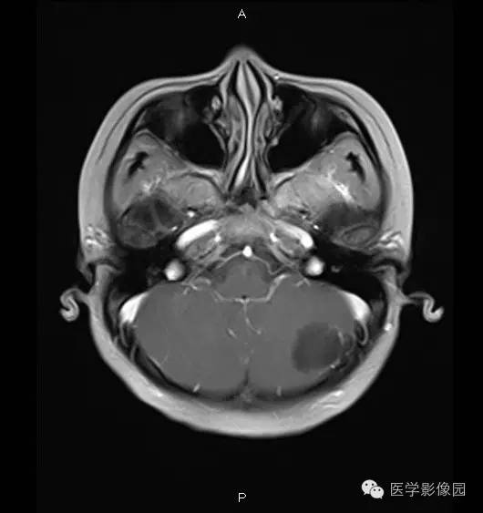 【病例】小脑半球表皮样囊肿1例MR影像表现