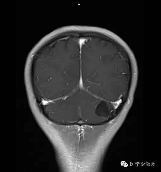 【病例】小脑半球表皮样囊肿1例MR影像表现