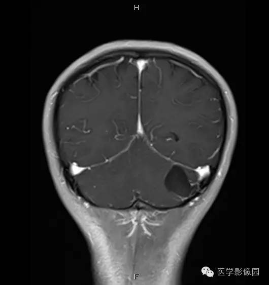 【病例】小脑半球表皮样囊肿1例MR影像表现