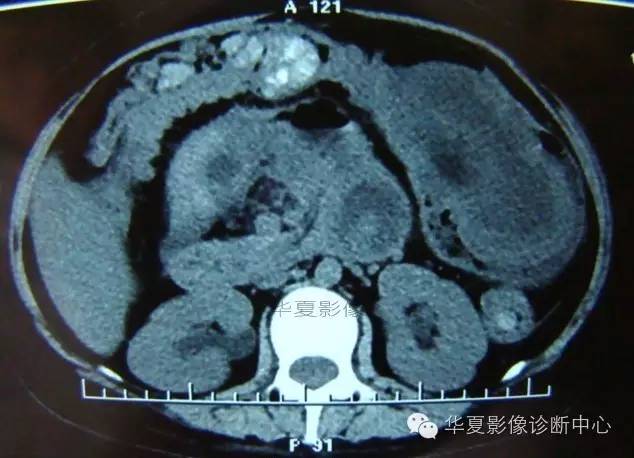【病例】黑斑息肉病并肠套叠1例CT影像表现