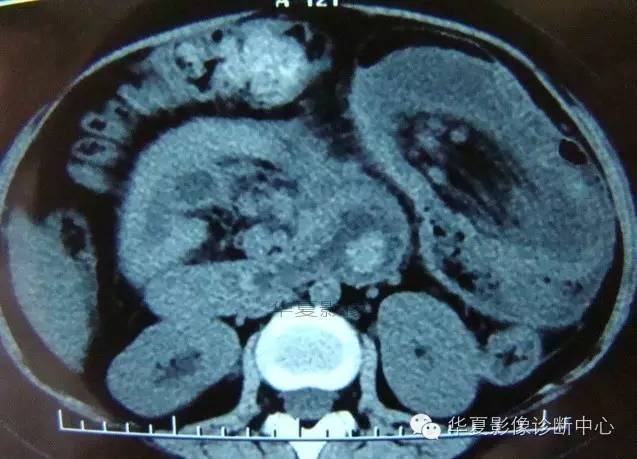 【病例】黑斑息肉病并肠套叠1例CT影像表现
