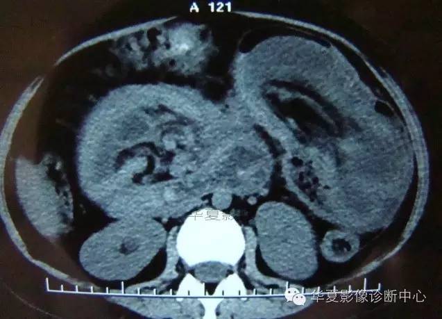 【病例】黑斑息肉病并肠套叠1例CT影像表现