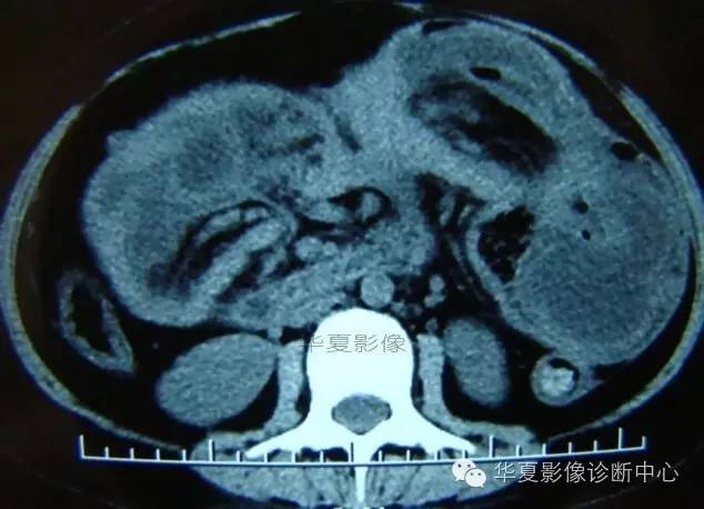 【病例】黑斑息肉病并肠套叠1例CT影像表现