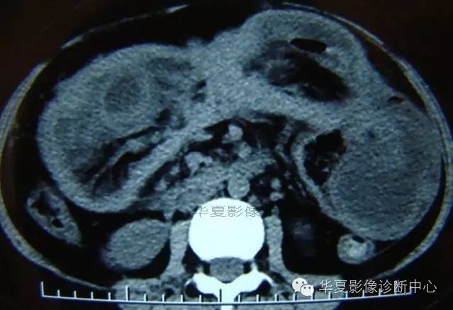 【病例】黑斑息肉病并肠套叠1例CT影像表现