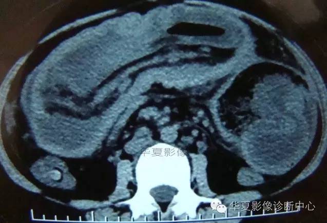 【病例】黑斑息肉病并肠套叠1例CT影像表现