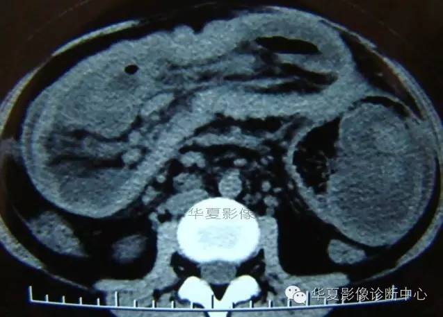【病例】黑斑息肉病并肠套叠1例CT影像表现