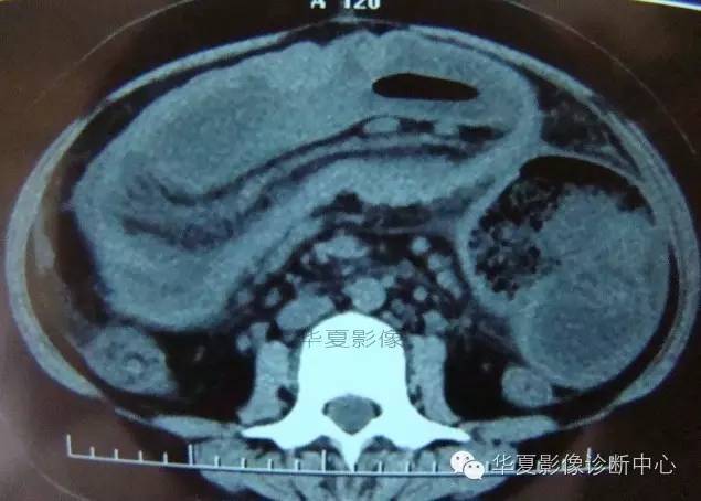 【病例】黑斑息肉病并肠套叠1例CT影像表现