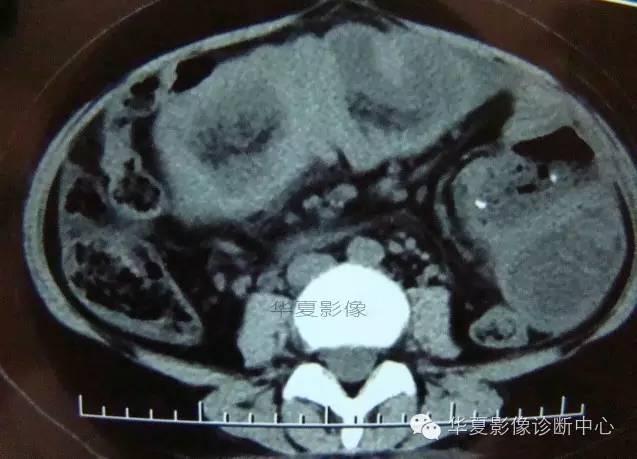 【病例】黑斑息肉病并肠套叠1例CT影像表现
