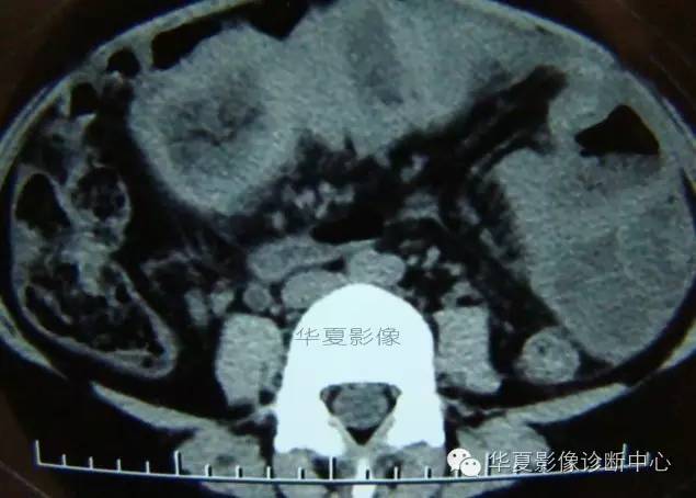 【病例】黑斑息肉病并肠套叠1例CT影像表现