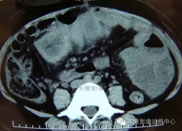 【病例】黑斑息肉病并肠套叠1例CT影像表现