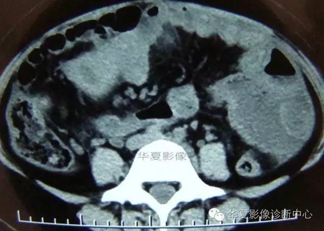 【病例】黑斑息肉病并肠套叠1例CT影像表现