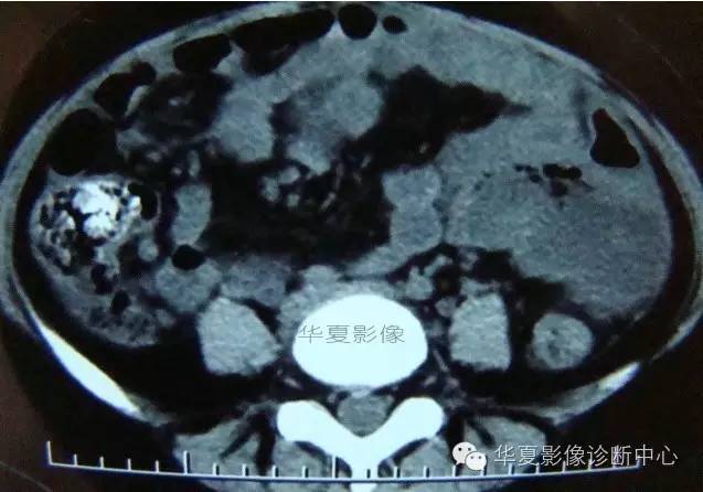 【病例】黑斑息肉病并肠套叠1例CT影像表现