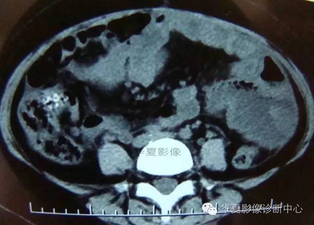 【病例】黑斑息肉病并肠套叠1例CT影像表现