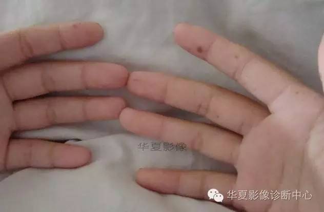 【病例】黑斑息肉病并肠套叠1例CT影像表现