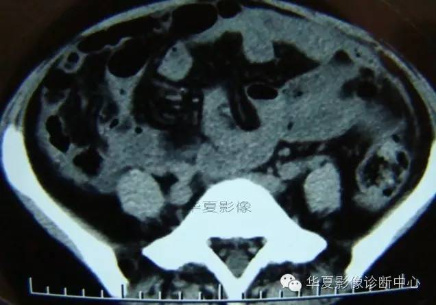 【病例】黑斑息肉病并肠套叠1例CT影像表现
