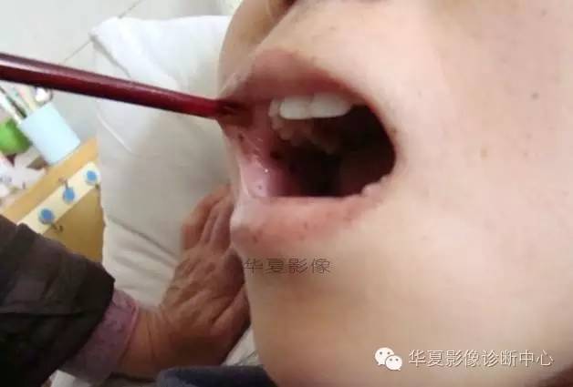 【病例】黑斑息肉病并肠套叠1例CT影像表现