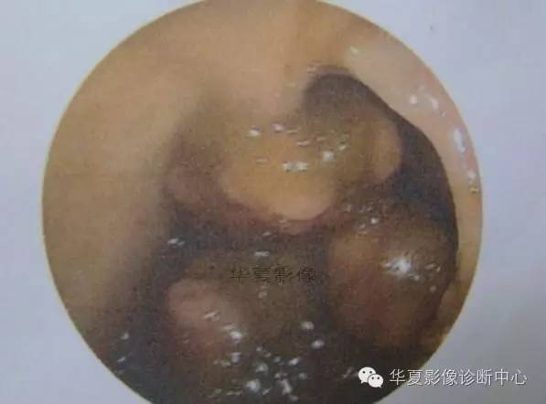 【病例】黑斑息肉病并肠套叠1例CT影像表现