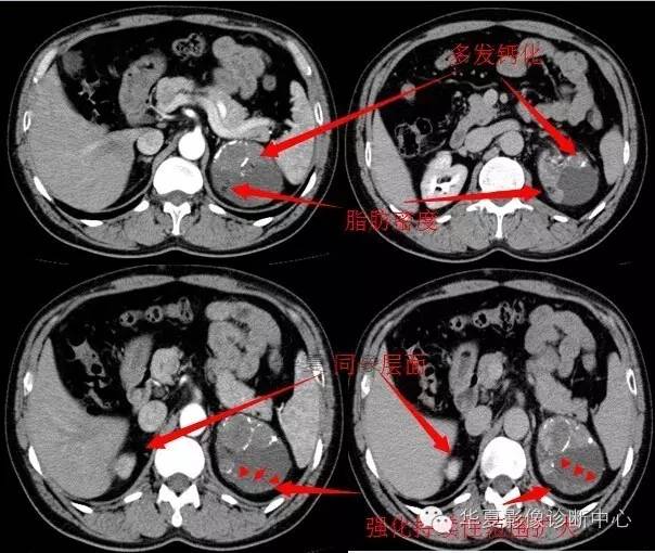 【病例】肾上腺血管瘤1例CT影像表现 【病例】肾上腺血管瘤1例CT影像表现