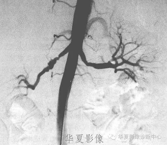 【病例】肌纤维发育不良性肾动脉狭窄一例X线(DSA)影像表现