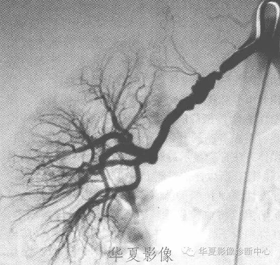 【病例】肌纤维发育不良性肾动脉狭窄一例X线(DSA)影像表现 【病例】肌纤维发育不良性肾动脉狭窄一例X线(DSA)影像表现